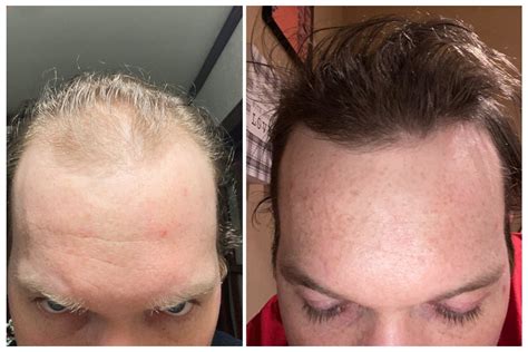 Best Finasteride For Hair Loss 🧬 Andro Genetic