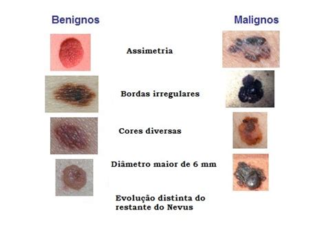 Cuidado Os Sinais Tudo O Que Precisas De Saber Sobre Eles