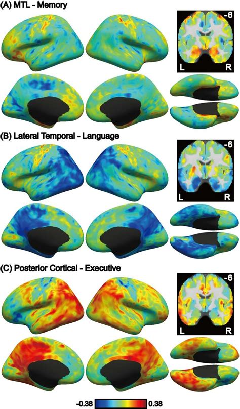 correlation  atrophy cognitive factor loading  tau deposition