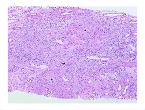 Granulomatous Interstitial Nephritis With Non Necrotizing Epithelioid