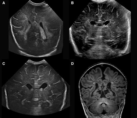 Neuroimaging Of The Preterm Brain Review And Recommendations The