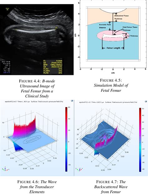 Cancellous Bone Density Evaluation using Ultrasound Backscatter from an ...