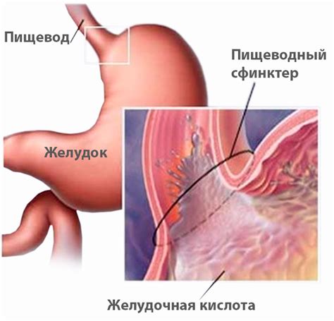 Диспепсия