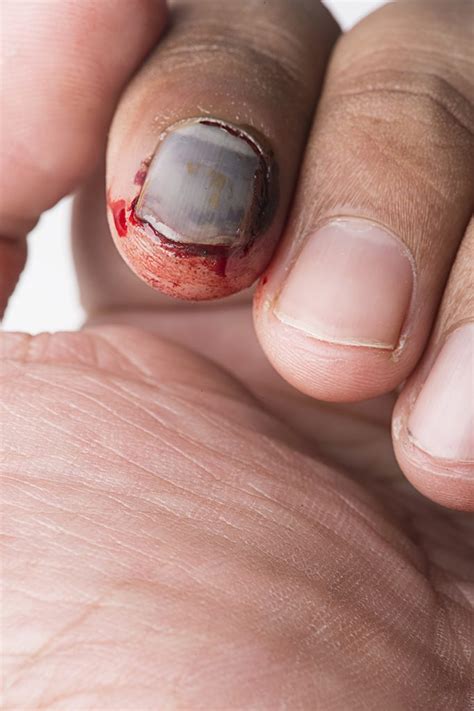 Nail Bed Injury Zaf Naqui
