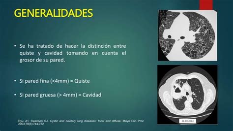 Lesiones Pulmonares Cavitadas