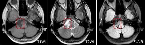 Frontiers The Spectrum Of Vestibular Disorders Presenting With Acute Continuous Vertigo