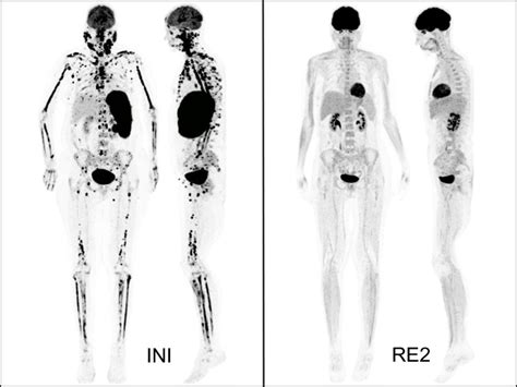 Female Patient With Diffuse Large B Cell Lymphoma And Multifocal Bone