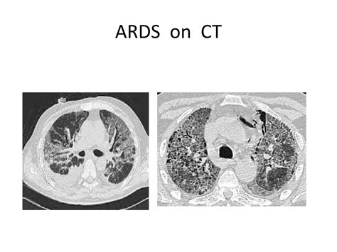 Acute Respiratory Disease Syndromeppt