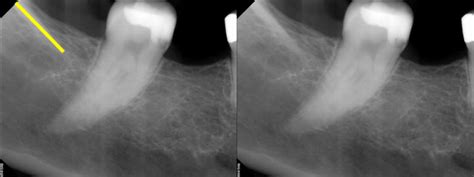 Anatomy Monday Anatomy On Mandibular Periapical Radiographs Dr G S