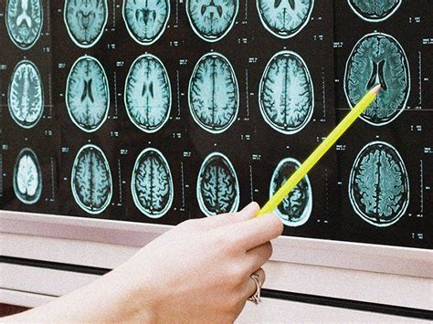 Brain Metastases Symptoms Prognosis Diagnosis And More