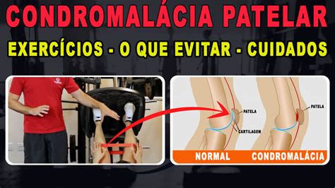 Condromalácia patelar o que é exercícios e tratamento Treino Mestre