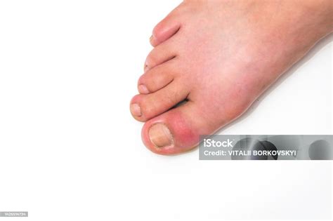 Gota No Dedão Do Pé - Foto de Gota Ou Podagra No Dedão Do Pé Aparece Como Vermelhidão E Uma ...