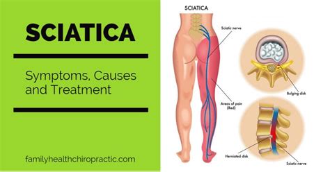 sciatica symptoms causes and treatment by austin chiropractor | Family Health Chiropractic