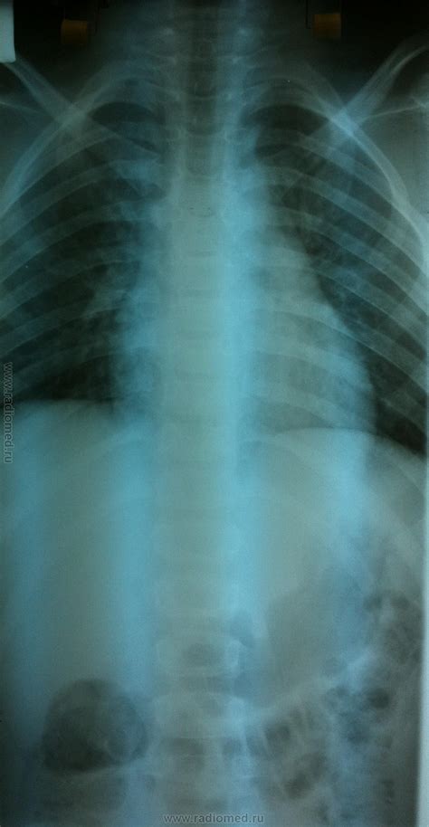 Кататравма | Портал радиологов