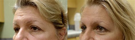 Eyelid Chalazion Stye Surgery In Focus Ophthalmic Plastic Surgery