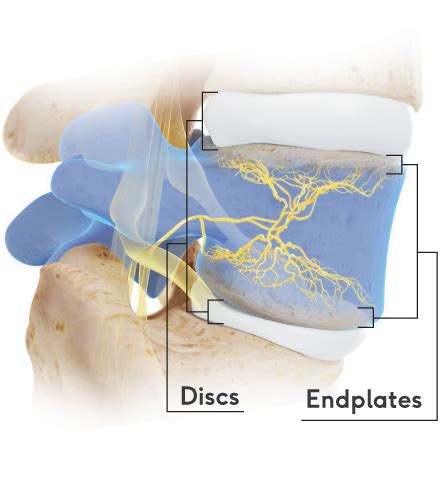 Vertebrogenic Pain - The Intracept Procedure by Relievant