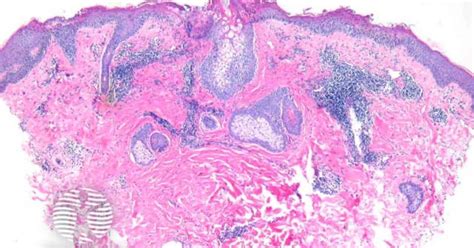 Tinea Corporis Pathology Image