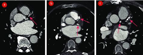 Coronary artery calcification detection on CT pulmonary venograms. (a ...