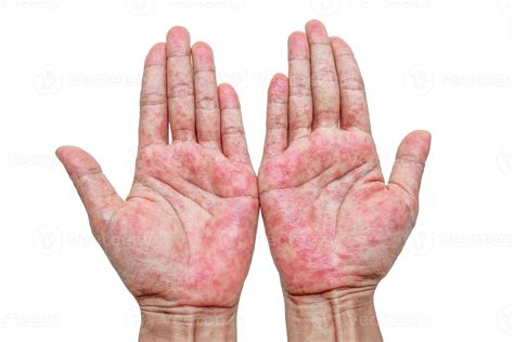 Hands With Rash Red Sports On The Hand Palm And Fingers