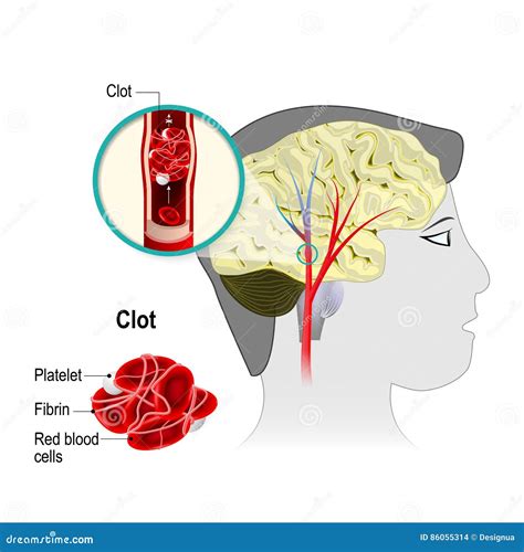 Cerebral Infarkt Vektor Illustrationer Illustration Av Ateroskleros