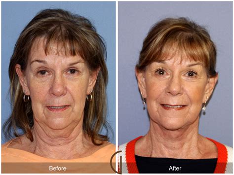 Today’s Best Cosmetic Surgery Review Site Featured One Of Newport Beach Facial