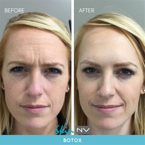 Before & After Gallery | Tampa Fillers, Botox, Lasers & More | Skin NV