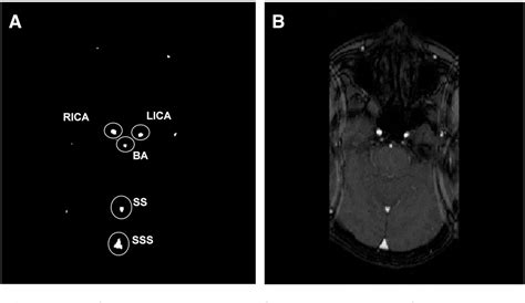 Figure From Measuring Steady State Cerebral Vasomotor Reactivity