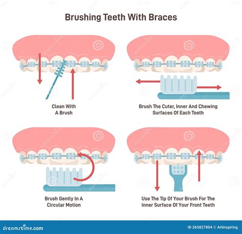 Brushing Teeth with Braces System. Oral Care with Special Brush Stock Vector - Illustration of