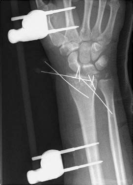 Orthopedic Hardware And Complications Radiology Key