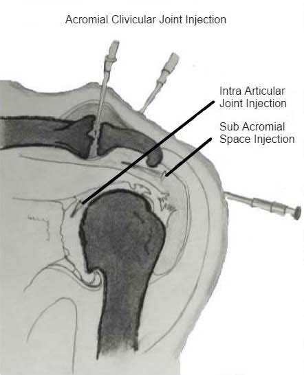 The Shoulder Practice Cape Town Shoulder Impingement