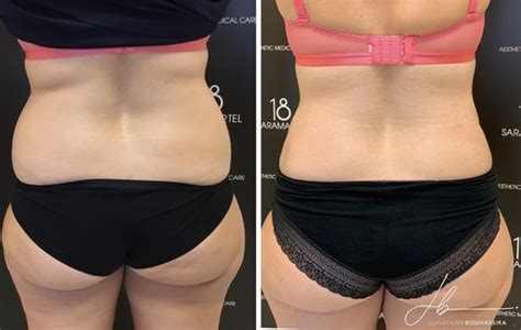 Liposuccion Dr Bouhassira Sp Cialiste Cannes Antibes De La Liposuccion