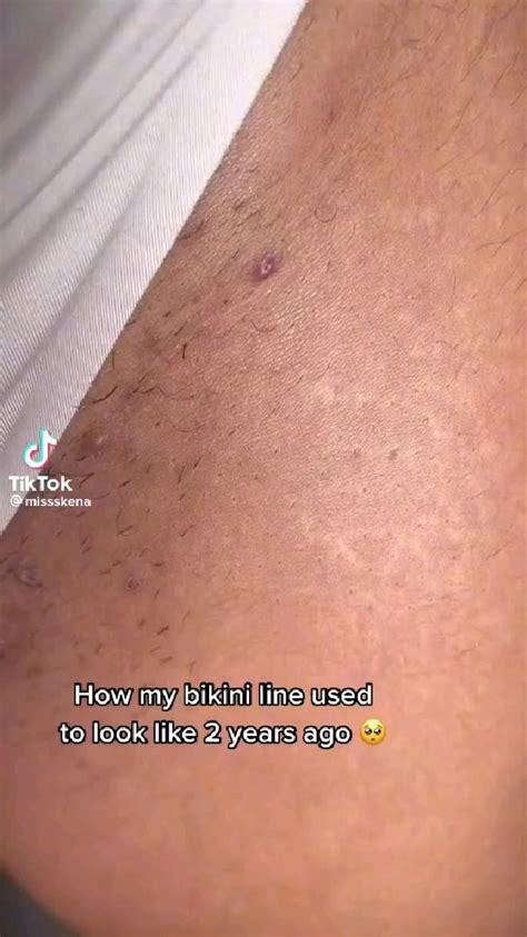 Best Bikini Line Before And After Artofit