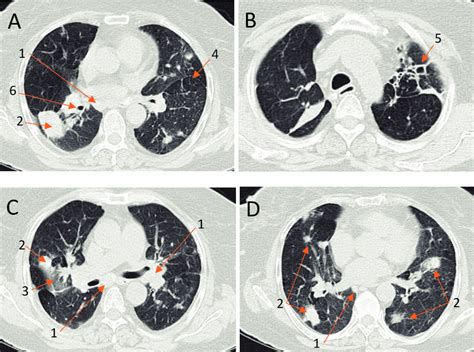 Chest Computed Tomography Scan CT A D These Images Reveal