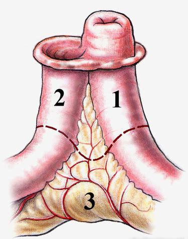 Viscera Operationen R Ckverlagerung Ileostoma