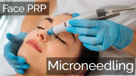 Microneedling Treatment With Face Prp Platelet Rich Plasma Urban