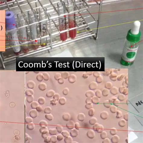 coombs test direct test price  delhi cost   india