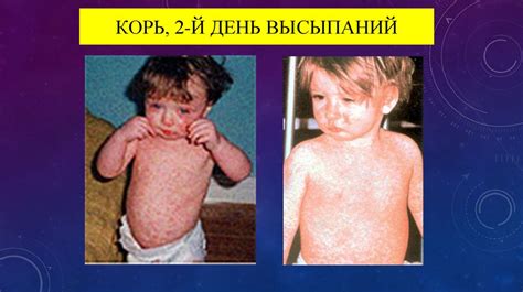 Корь(MORBILLI) - презентация онлайн