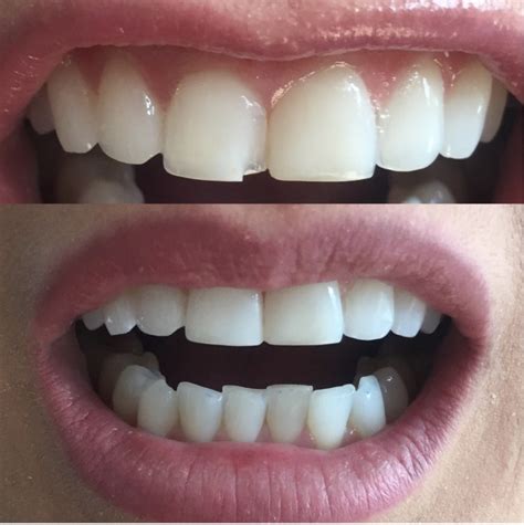 COMPOSITE RESIN VENEERS Brisbane Smile Boutique Dentists Brisbane