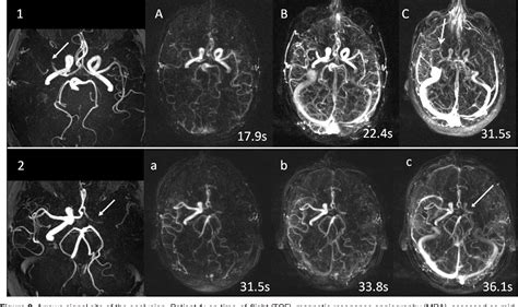 Figure 2 From Dynamic Magnetic Resonance Angiography Provides Collateral Circulation And