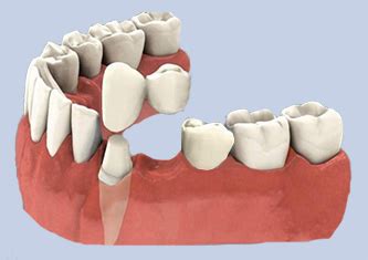 Cantilever Dental Bridge