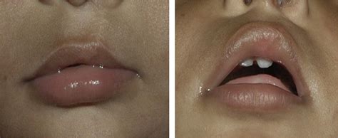 A New Tailored Technique Of Vermilion Repair In Unilateral Cleft Lip