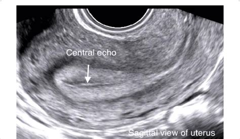 Sagittal Uterus Ultrasound