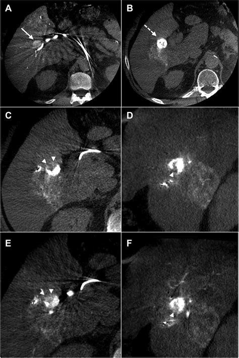 Perspectives Of Cone Beam Computed Tomography In Interventional