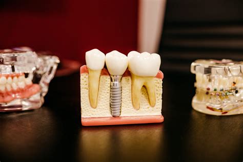 Dentures Vs Dental Implants What You Need To Know Idental