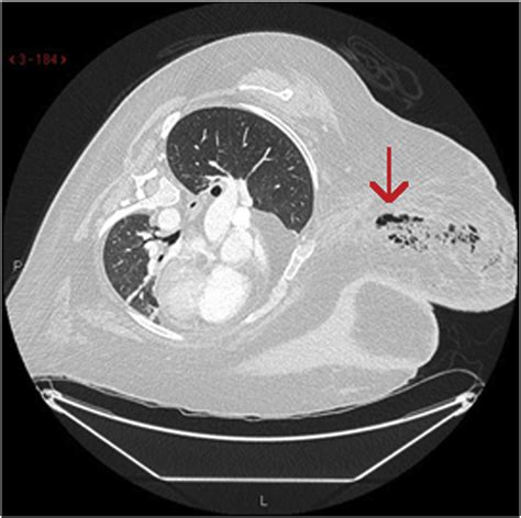 CT Imaging Of Right Breast Demonstrating Extensive Soft Tissue Gas