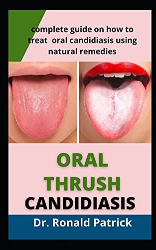 Oral Thrush Candidiasis Complete Guide On How To Treat Oral