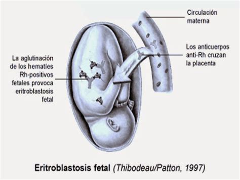 Eritroblastose Fetal O Que É - Patologías de Oído: Eritroblastosis fetal o enfermedad hemolítica del ...