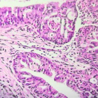 Microscopic View Of Oncocytic Schneiderian Papilloma A Predominantly