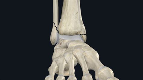 Ankle Fractures OrthoPedia