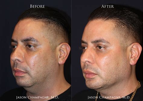 Custom Chin And Jaw Implants Gallery Beverly Hills Plastic Surgeon